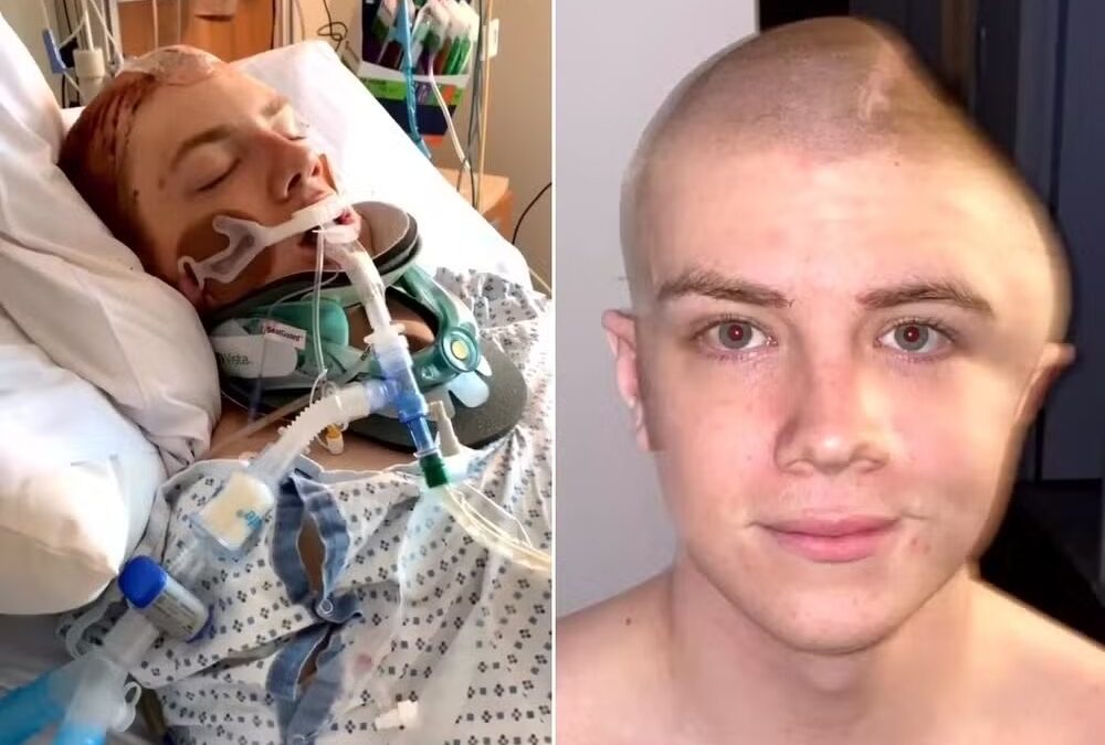 Após queda de skate, rapaz contrai infecção e tem o crânio removido para lavagem do cérebro Brandon Alexander passará por mais duas cirurgias