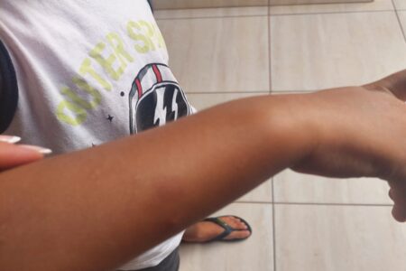 Imagem mostra hematomas no braço de menino agredido por professora em escola particular em Anápolis.