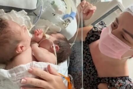 Gêmeas siamesas Lara e Larissa: cateterismo no Hugol (Foto: Divulgação/Hecad)