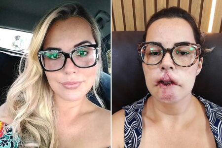 Mulher perde o lábio superior após fazer preenchimento com PMMA Mariana Michelini pensou que o procedimento seria feito com ácido hialurônico