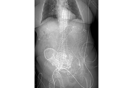 Idosa morre após cirurgia para retirada de feto calcificado no MS