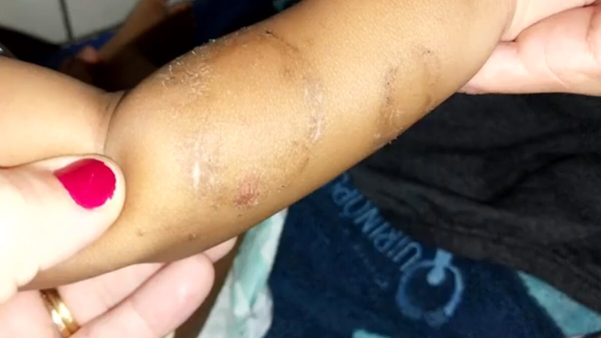 Marca de mordida no braço do bebê de 1 ano