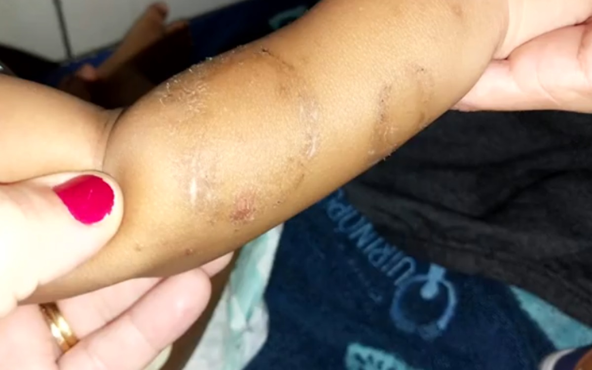 Marca de mordida no braço do bebê de 1 ano