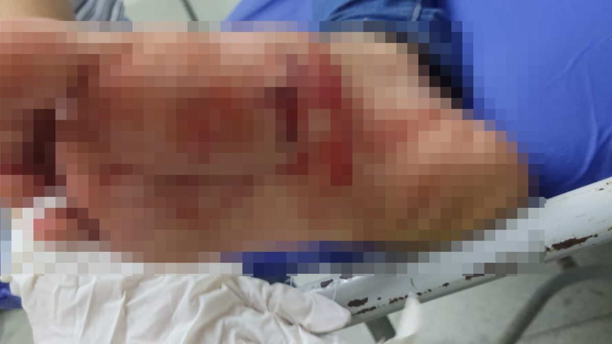 Imagem colorida mostra pé de mulher ferido a faca por companheiro que acabou preso (Foto: PM)