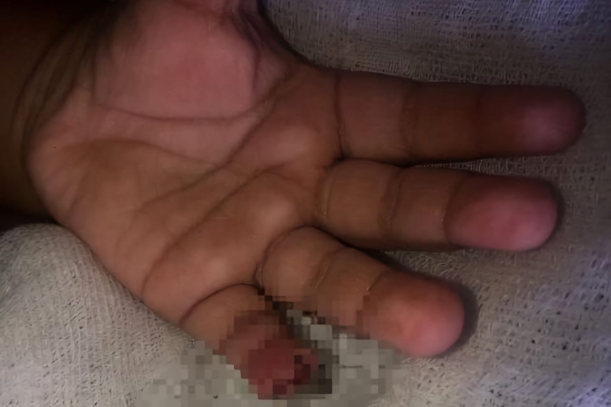 Mulher denuncia que filho perdeu pedaço do dedo em CMEI de Itumbiara