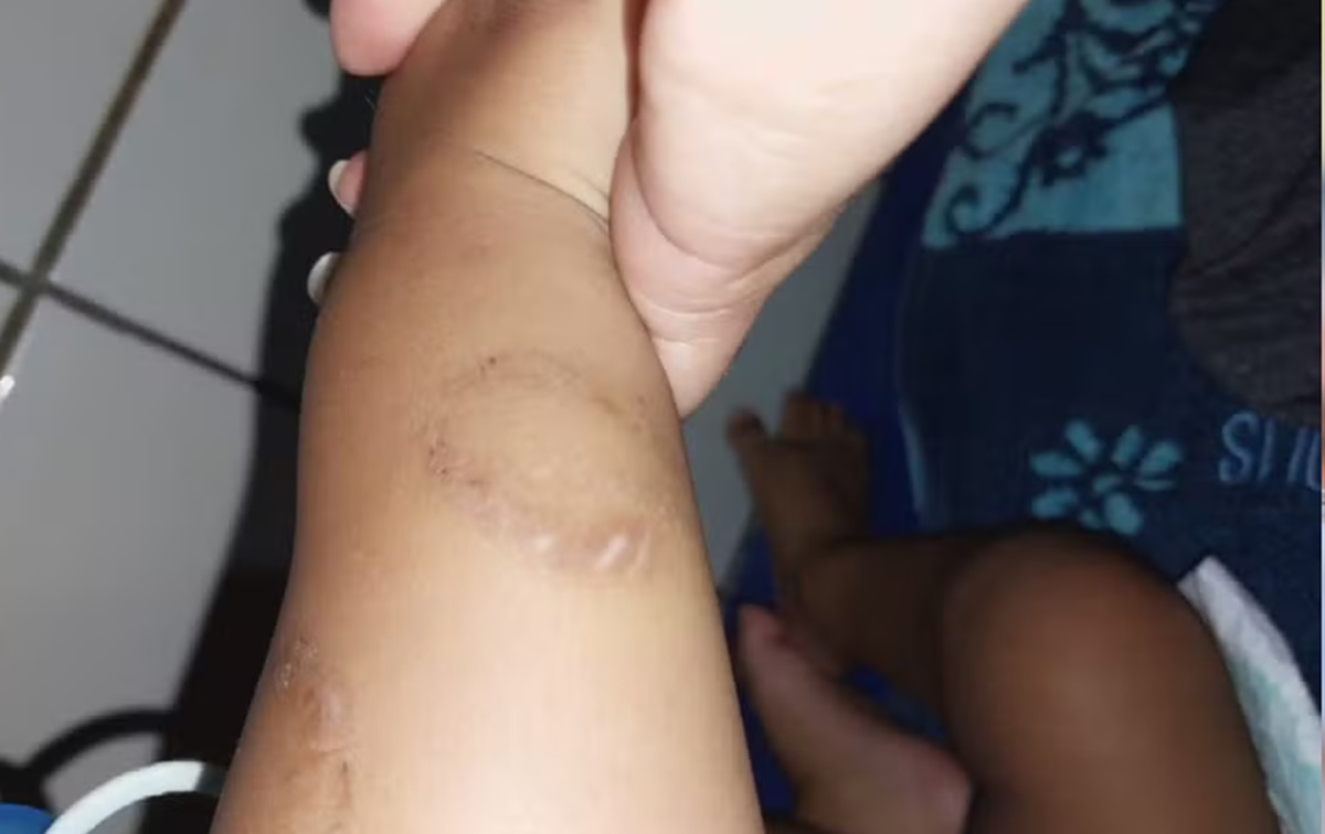 Quirinópolis: Bebê torturado continua internado em estado gravíssimo no Hugol