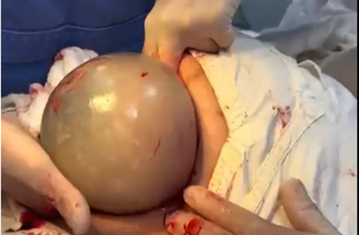 Bebê nasce ‘empelicado’ em hospital de Iporá