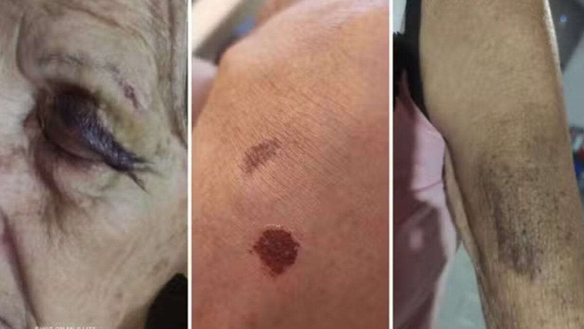 Fotos coloridas mostram hematomas que sogra da pedagoga Fábia Cristina Santos afirma terem sido provocados por policiais civis de Goiás (Fotos: divulgação)