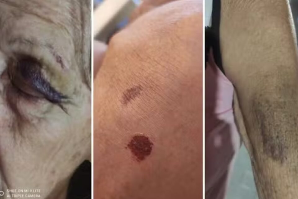 Fotos coloridas mostram hematomas que sogra da pedagoga Fábia Cristina Santos afirma terem sido provocados por policiais civis de Goiás (Fotos: divulgação)