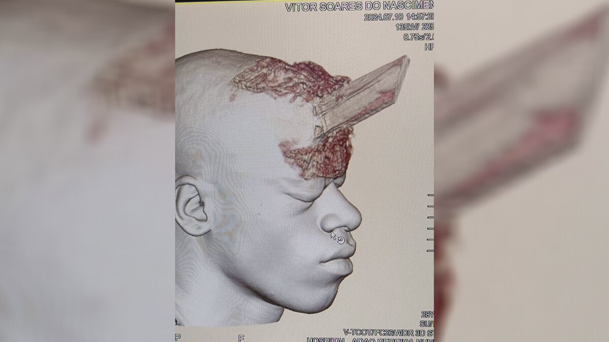 Exame mostra como ficou pedreiro que teve crânio perfurado por estaca de madeira durante acidente de trabalho no RJ (Imagem: reprodução)