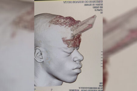 Exame mostra como ficou pedreiro que teve crânio perfurado por estaca de madeira durante acidente de trabalho no RJ (Imagem: reprodução)