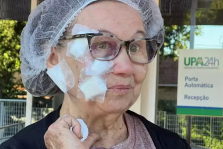 Idora que foi atacada por pitbull e tomou 50 pontos no rosto (Foto: Reprodução)