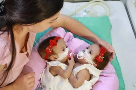 Morrem gêmeas siamesas Lara e Larissa, em Aparecida de Goiânia