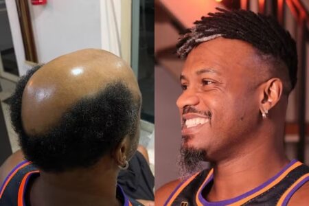 Barbearia com técnica de dreads em calvos chega no Distrito Federal: "agora tenho cabelo" Procedimento é conhecido como baldlocs