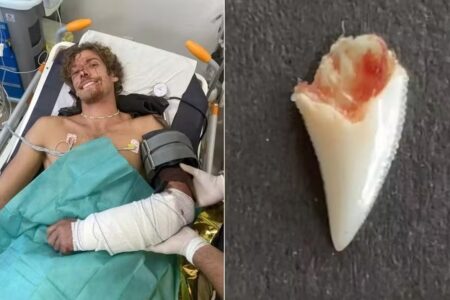 Jovem faz brincos com dentes de tubarão que o atacou Angus Kockott esfaqueou o predador e ficou com os dentes do animal cravados no braço