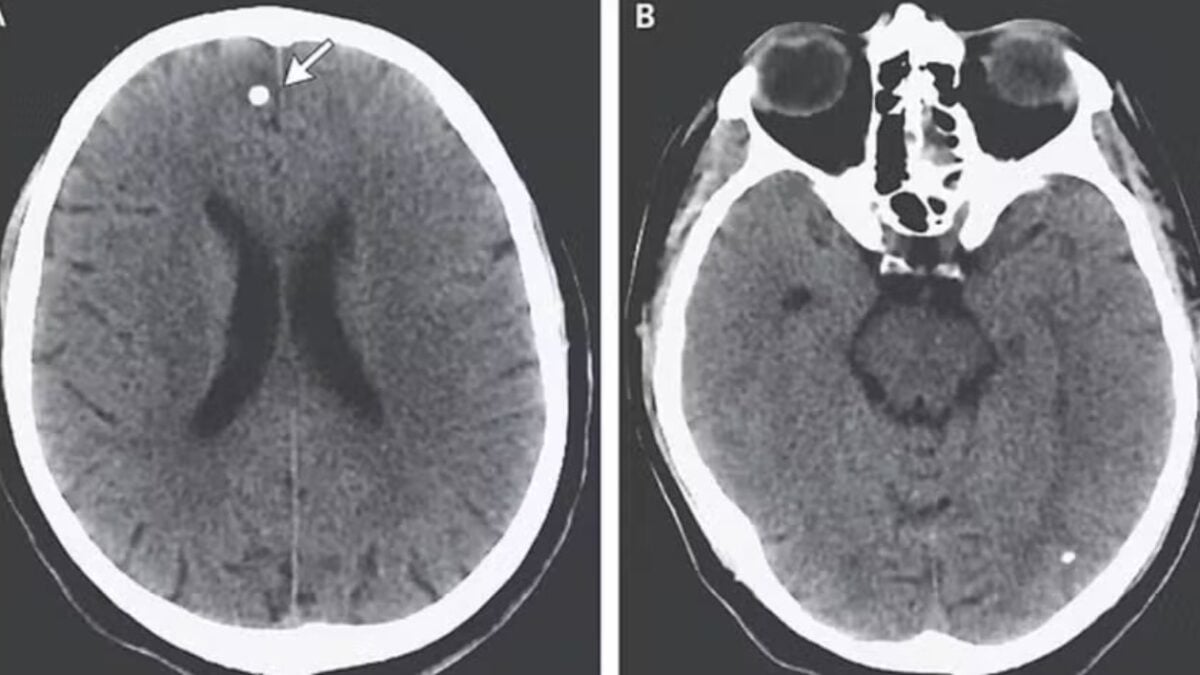 Mulheres compram ovos de tênia na dark web para comer e emagrecer (Foto: reprodução)