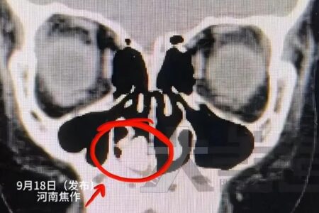 Objeto estava enferrujado; caso aconteceu na China Menino que ficou 2 anos sentindo 'cheiro estranho' tem parafuso retirado do nariz