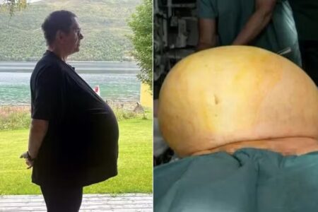 Médico descobre que homem tratado com Ozempic tinha na verdade um tumor de 27kg na barriga Foi um verdadeiro Thomas Kraut