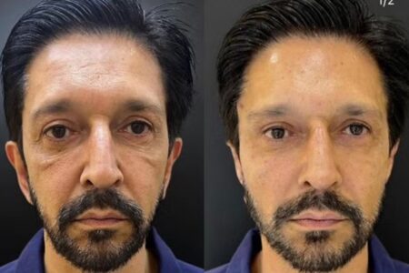 Prefeito de São Paulo, Ricardo Nunes, foi presenteado com harmonização facial político queria "reduzir a flacidez do rosto e as olheiras"