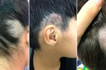 Médicos alertam para aumento de micoses causadas por fungos transmitidos em barbearias O fungo Trichophyton tonsurans