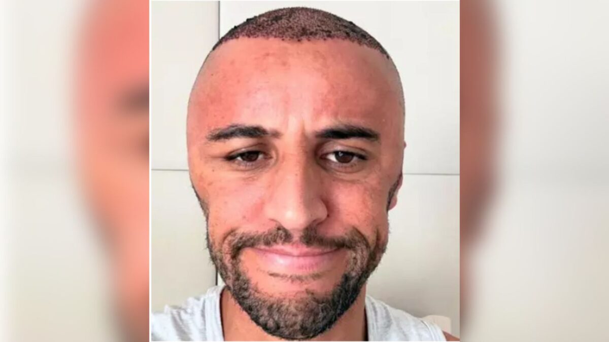 O influenciador Wesley Alemão, após a cirurgia de transplante capilar (Foto: Reprodução/Redes Sociais)