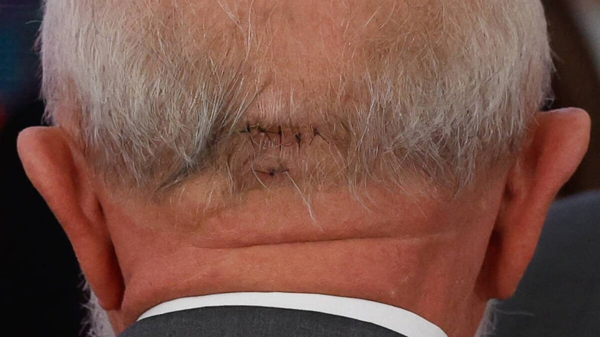 'Presidente encontra-se bem', diz boletim médico após cirurgia de Lula Petista passou por cirurgia no Hospital Sírio-Libanês e segue na UTI