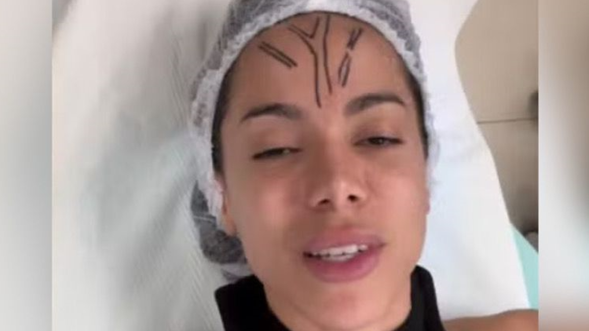 Anitta remove veia da testa (Foto: Reprodução/Redes Sociais)