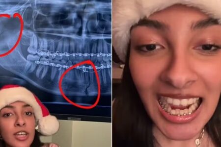 Jovem sofre fraturas no maxilar ao morder doce quebra-queixo A canadense Javeria Wasim teve o maxilar fraturado em dois lugares