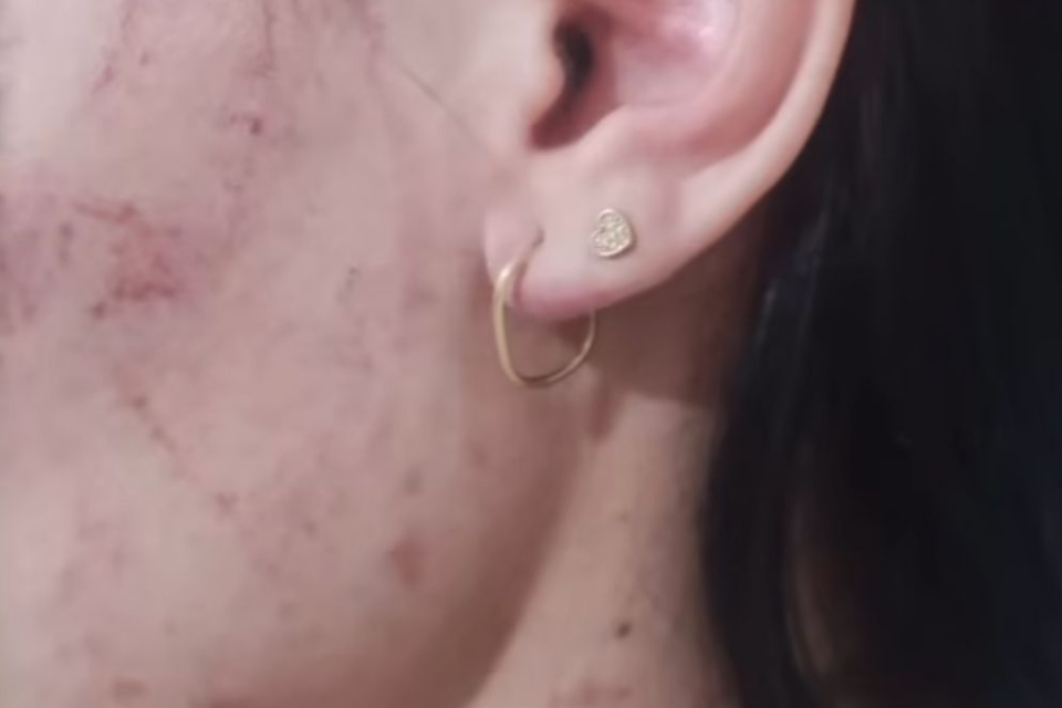 Imagem colorida mostra parte do rosto de uma mulher com marcas de agressão.