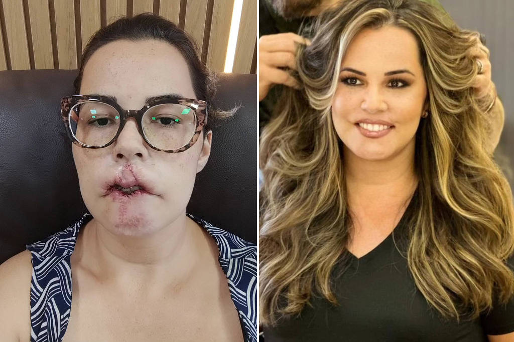 Mulher que perdeu lábio por PMMA termina cirurgias de reconstrução; veja resultado