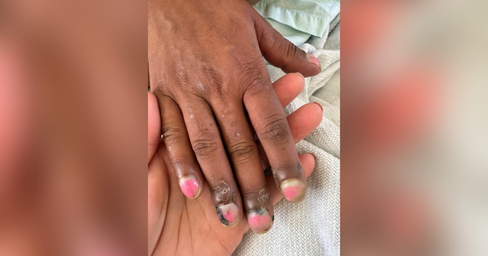 A imagem mostra a mão da vítima com os dedos inchados e hematomas