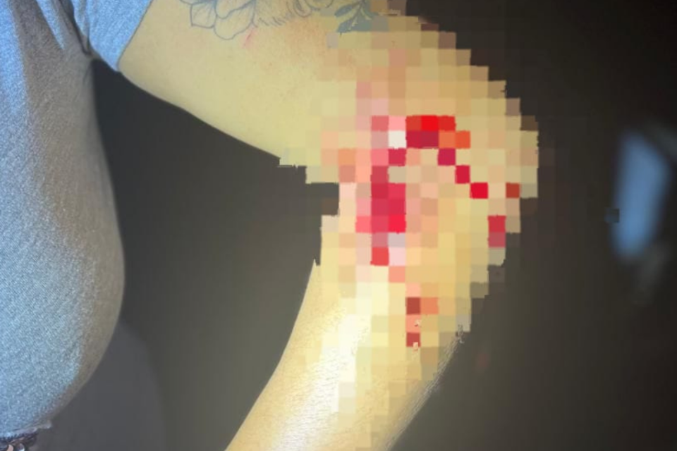 Imagem colorida e borrada mostra parte do braço de uma mulher cortado e sangrando.