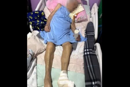 Idosa de 103 anos tem pé amputado sem anestesia e com bisturi cego no DF Cirurgia clandestina foi realizada num apartamento, na Asa Norte