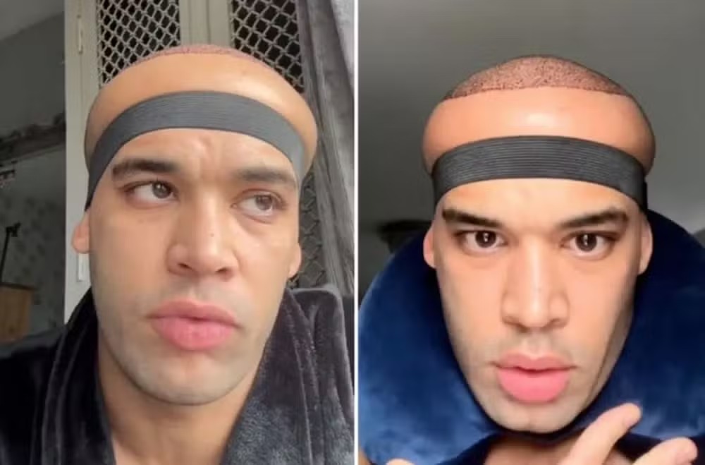 Homem viraliza ao ficar parecido com 'Megamente' após transplante capilar; foto Kanah Flex também se comparou a Lula Molusco de 'Bob Esponja'