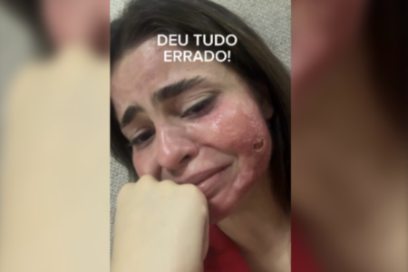 Médica Isadora Milhomem compartilha resultado negativo de procedimento estético (Foto: Reprodução)