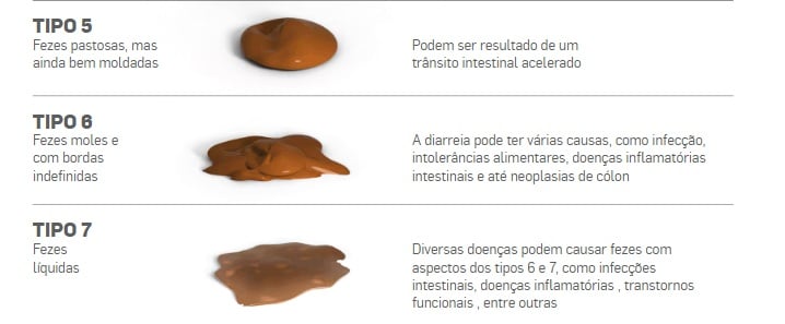FONTES: SU BONG KIM, CIRURGIÃO DO APARELHO DIGESTIVO DO HOSPITAL ALEMÃO OSWALDO CRUZ (SP), E VICTOR SEID, MEMBRO TITULAR DA SOCIEDADE BRASILEIRA DE COLOPROTCOLOGIA (SBCP) (Infográfico: Estadão)