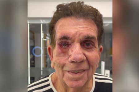 Reinaldo após tatuagem no globo ocular (Foto: Reprodução)