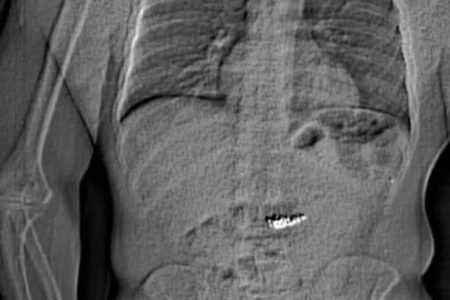 Ladrão engole joias ao ser cercado pela polícia e é flagrado no raio-x "Deveria ter jogado pela janela", disse americano