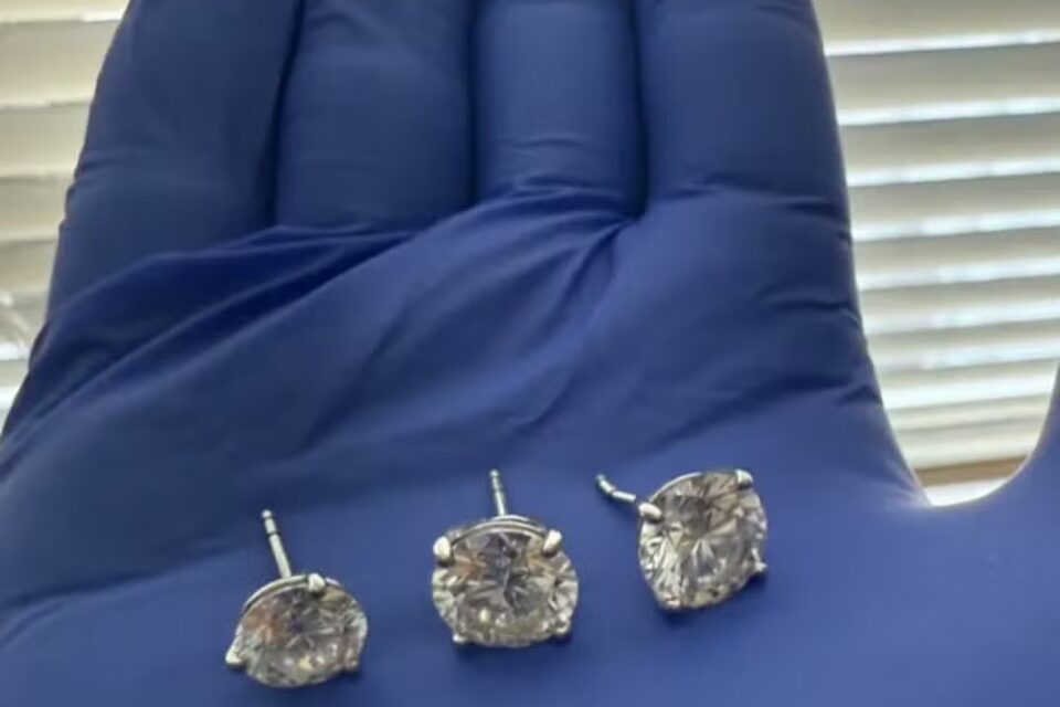 Polícia dos EUA recupera joias de R$ 4 milhões engolidas por ladrão raio-x divulgado pelas autoridades mostraram objetos no estômago