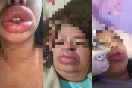 Falsa biomédica é indiciada após deformar bocas de pacientes em Campo Grande Ana Carolina Brites é investigada por procedimentos ilegais