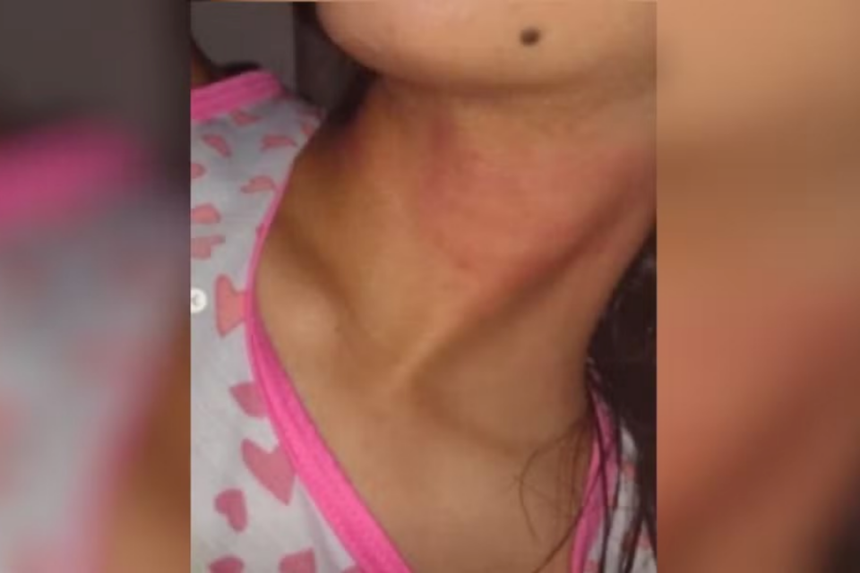A imagem mostra as marcas da esganadura