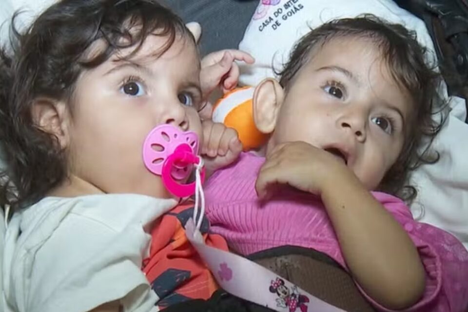 Siamesas separadas em Goiânia: estado de saúde de Aruna é grave, diz hospital