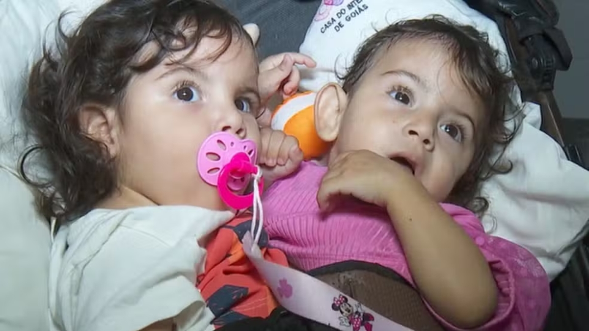 Siamesas separadas em Goiânia: estado de saúde de Aruna é grave, diz hospital