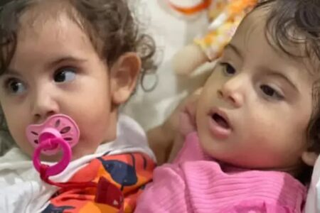 Hospital confirma morte encefálica de Kiraz, gêmea siamesa separada em Goiânia