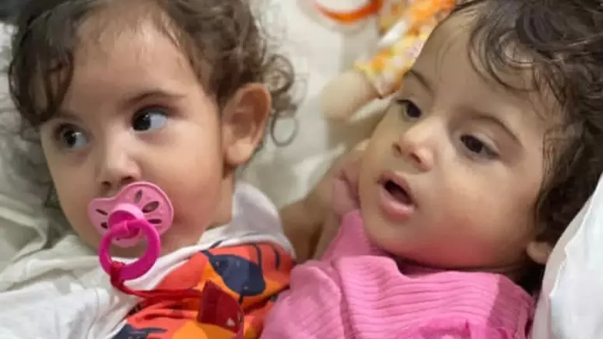 Hospital confirma morte encefálica de Kiraz, gêmea siamesa separada em Goiânia