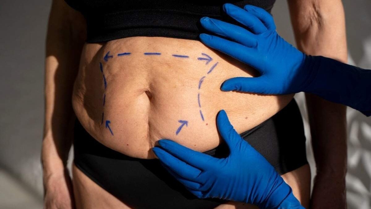 Novas regras para bariátrica permitem cirurgia a partir dos 14 anos; veja o que mudou Índice de IMC recomendado agora é mais baixo