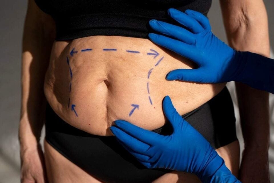 Novas regras para bariátrica permitem cirurgia a partir dos 14 anos; veja o que mudou Índice de IMC recomendado agora é mais baixo