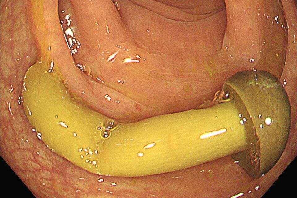 Médico descobre cogumelo crescendo no intestino de paciente; veja foto