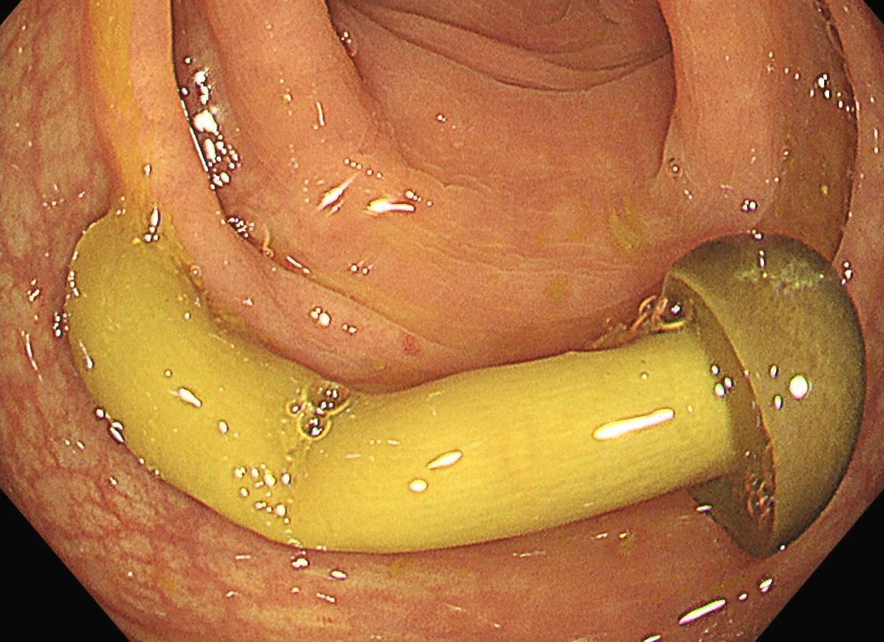 Médico descobre cogumelo crescendo no intestino de paciente; veja foto