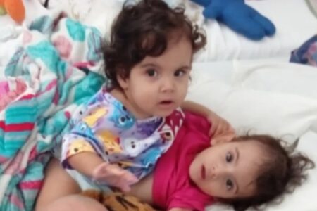 Siamesa sobrevivente: Aruna segue em estado grave, mas em 'desmame gradual da sedação'